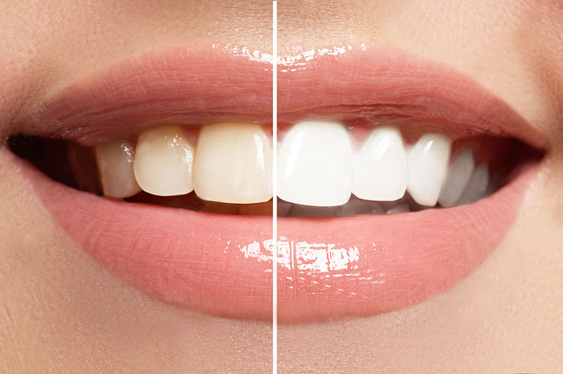 Dental Veneers